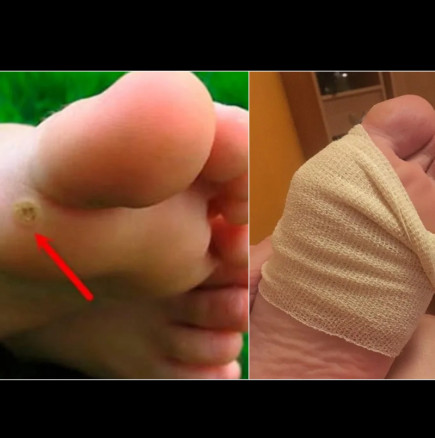 Безболезнен метод за премахване на кокоши трън за 4 дни: Баба ми ме научи на това, прилагам го от години!