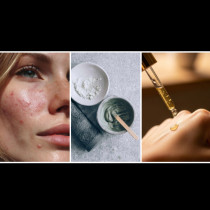 СЕДЕМ съставки, които трябва да избягвате, ако имате кожа, склонна към акне (само влошават проблема)