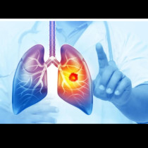 Най-опасният рак при жените често е пренебрегван. Това са симптомите, които трябва да знаете