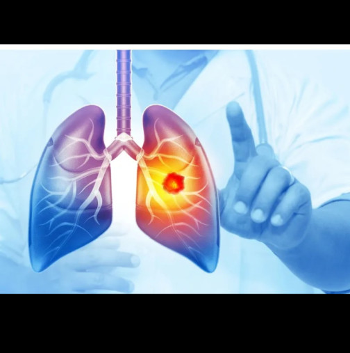 Най-опасният рак при жените често е пренебрегван. Това са симптомите, които трябва да знаете