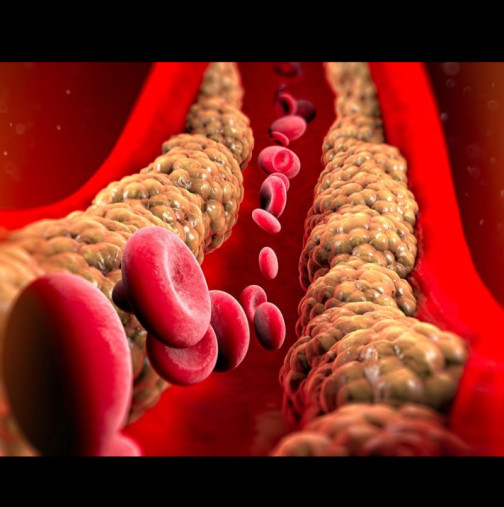 Как да почистите кръвоносните съдове от холестерол по естествен път: 3 вида храни, които работят
