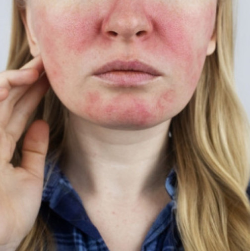 Влошава се с възрастта: Никой не знае какво причинява това кожно заболяване, но ето как може да се контролира