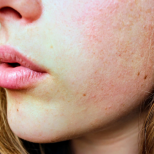 Ето как по лицето ви може да се разпознае липсата на витамин D