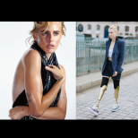 "Момичето със златните крака": Тя отиде на рожден ден, разболя се и часове по-късно загуби и двата си крака заради това