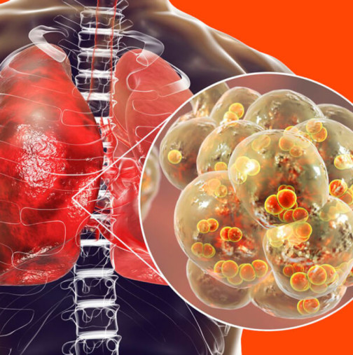 По какво се разпознава пневмонията - симптоми и лечение