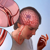 Възстановяване след инсулт: Учените откриват какво може да помогне на тялото да се възстанови, всичко зависи от това нещо