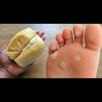 Кокоши трън, мазоли и груба кожа изчезват, сякаш не ги е имало! Стар, но ЗЛАТЕН трик със стар хляб: