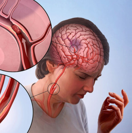 Възстановяване след инсулт: Учените откриват какво може да помогне на тялото да се възстанови, всичко зависи от това нещо