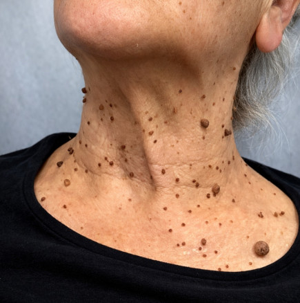 Притесняват ли ви папиломи и брадавици? Ето как можете да се отървете от тях ЗАВИНАГИ - лесно и безопасно!