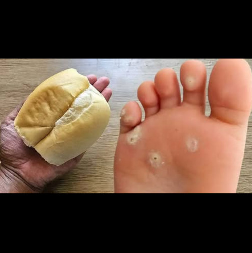 Кокоши трън, мазоли и груба кожа изчезват, сякаш не ги е имало! Стар, но ЗЛАТЕН трик със стар хляб: