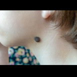 Защо по бенката растат косъмчета? Ето какво казват дерматолозите и дали трябва да ги докосвате