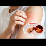 Сърбежът на кожата, заедно с 3 други симптома, показват рак на панкреаса: Ако забележите тези признаци, посетете Вашия лекар.