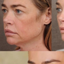 Снимките ПРЕДИ И СЛЕД, които шокираха интернет: Актрисата разкри как изглежда след фейслифт, а реакцията е буреносна!