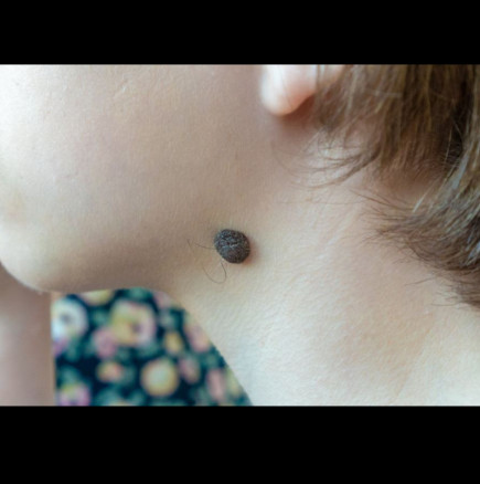 Защо по бенката растат косъмчета? Ето какво казват дерматолозите и дали трябва да ги докосвате