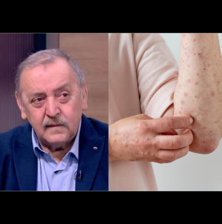 След случаите на морбили при неваксинирани деца проф.Кантарджиев предупреди: Може да има ужасяващи късни усложнения за мозъка