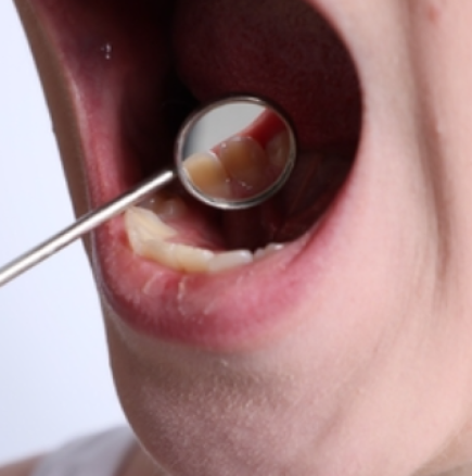 Зъболекар предупреждава: Този знак в устата може да е ранен симптом на рак