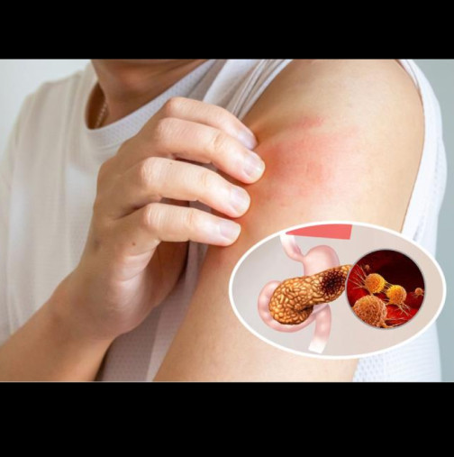 Сърбежът на кожата, заедно с 3 други симптома, показват рак на панкреаса: Ако забележите тези признаци, посетете Вашия лекар.