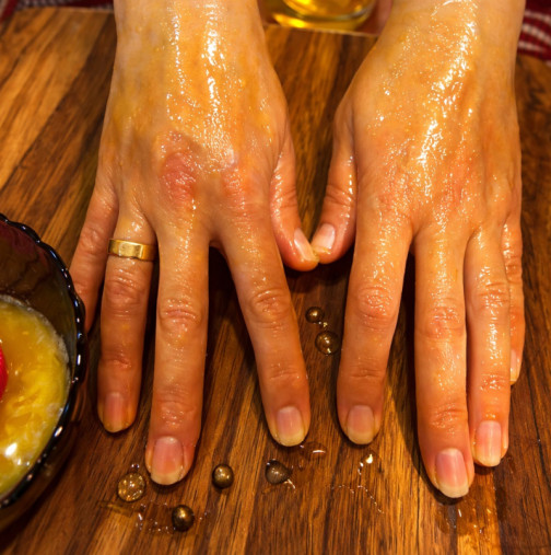 Козметичка съветва всеки, който страда от петна по ръцете: С това чудо ще изчезнат за 24 часа, а кожата ще стане по-красива!