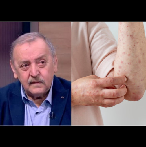 След случаите на морбили при неваксинирани деца проф.Кантарджиев предупреди: Може да има ужасяващи късни усложнения за мозъка