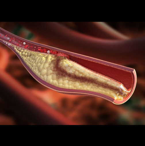 Ето как да разпознаете първия признак, че в тялото ви се образува тромб: Не трябва да пренебрегвате ТОЗИ симптом