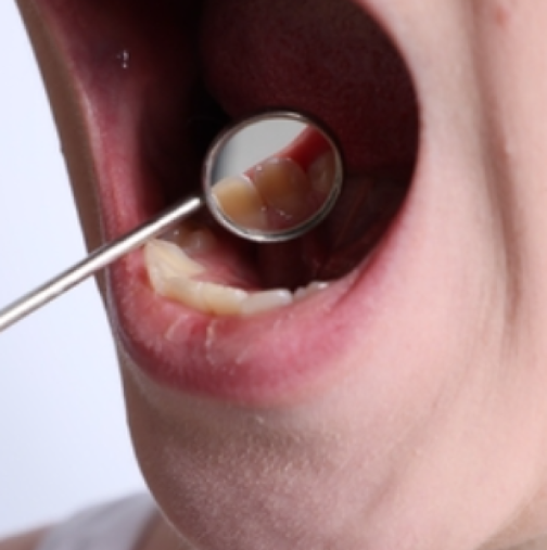 Зъболекар предупреждава: Този знак в устата може да е ранен симптом на рак