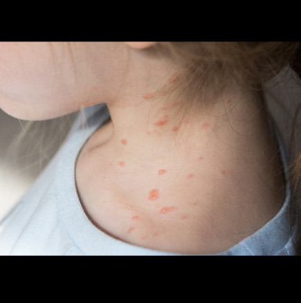 Първи случай на морбили в София!