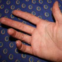 Първите признаци на рак се разпознават по дланите на ръцете
