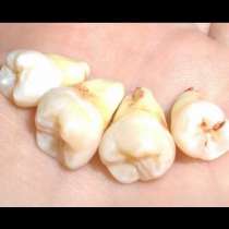 Изоставена зъболекарка извадила 32 здрави зъба от устата на бившия
