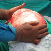 Лекари отстраниха 9-килограмова киста от яйчника на жена-снимка