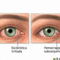Зачервени очи - знак за високо кръвно налягане, спуснати клепачи за инсулт