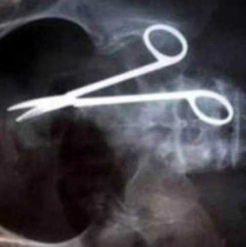 9 години агония! Мъж живя със забравена хирургическа ножица в стомаха