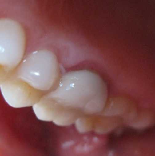 Зъбите ни ще се лекуват без зъболекарски машинки, без ...