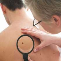 Всеки ден 13 души заболяват от рак на кожата в България