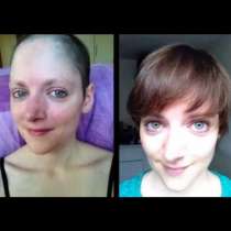 Това момиче победи рака - Ето за колко време й порасна косата-Видео