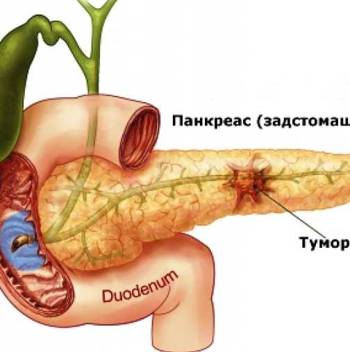 Как да намалите опасността от рак на панкреаса?