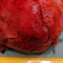 Лекари извадиха тумор по-голям от черния дроб