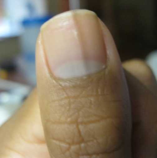 Проблеми с ноктите, който не трябва да игнорирате