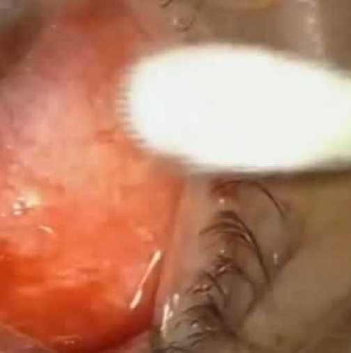 От окото на мъж беше изваден червей, дълъг цели 19 сантиметра! (Видео)