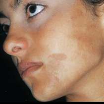 Ето как да се избавите от слънчевите алергии по кожата