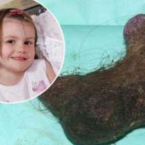 Само 30 хора в света боледуват от това: От корема на 5-годишно момиченце изваждат голяма топка косми, попаднала там по странен начин