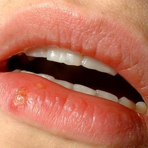 Най-важните неща които трябва да знаете за херпес на устата
