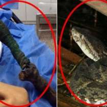 Шокиращи снимки: Ето какво се случи с крака на 13-годишно момиче, ухапано от змия