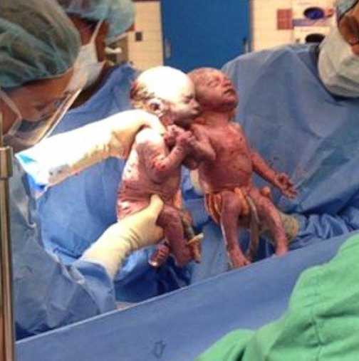 Помните ли близнаците, които се родиха, хванати за ръце? - Вижте колко са пораснали сега!