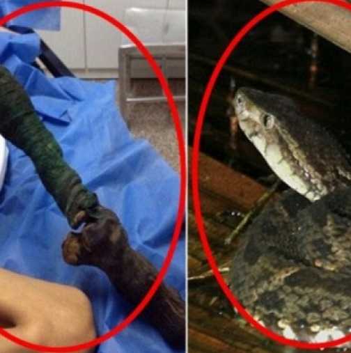 Шокиращи снимки: Ето какво се случи с крака на 13-годишно момиче, ухапано от змия