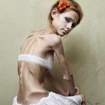 Ще настръхнете от тези снимки: Най-ужасяващите случай на анорексия