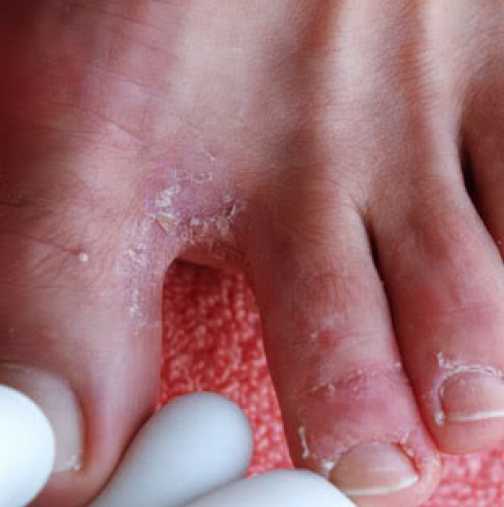 Лечение на гъбички по ноктите на краката със сода 