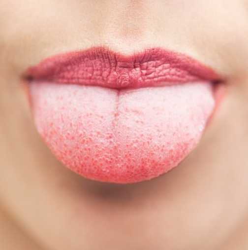 Езикът разкрива какво е вашето здраве: от алергия до сифилис, вижте симптомите