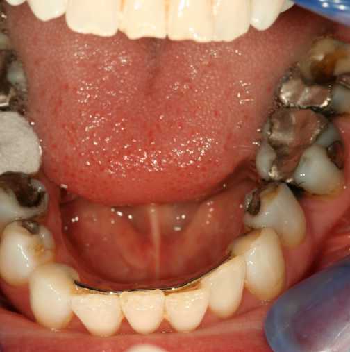 Извадете смъртоносните метални пломби от зъбите и ще се избавите от следните болести