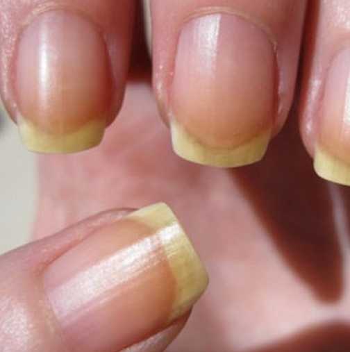Как да избелим естествено пожълтялите нокти?