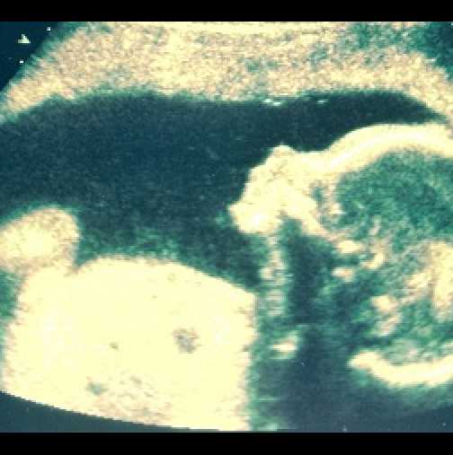  Мистерията на "бременото бебе": Бебе, родено с близнаци в корема